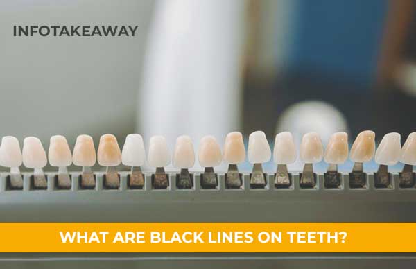 Black Lines On Teeth