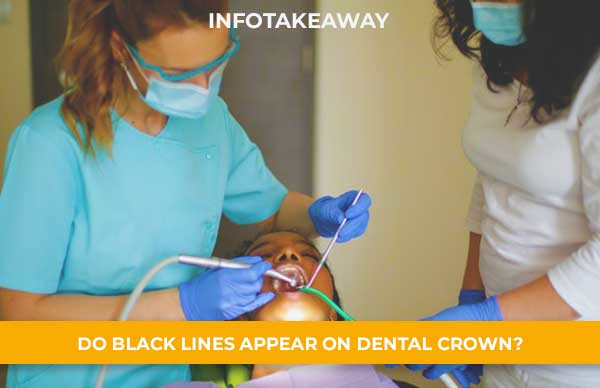 Do Black Lines Appear On Dental Crown